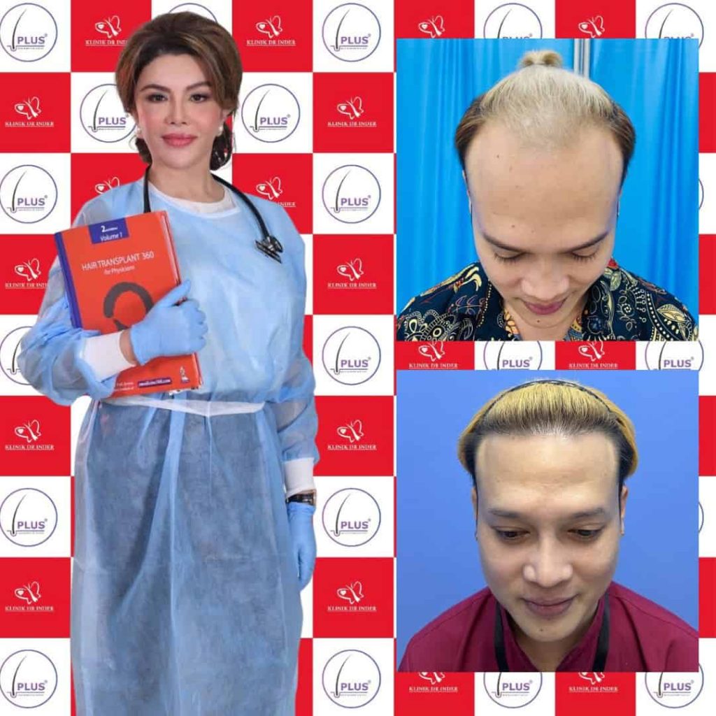Hair Transplant M Shap Befor After
