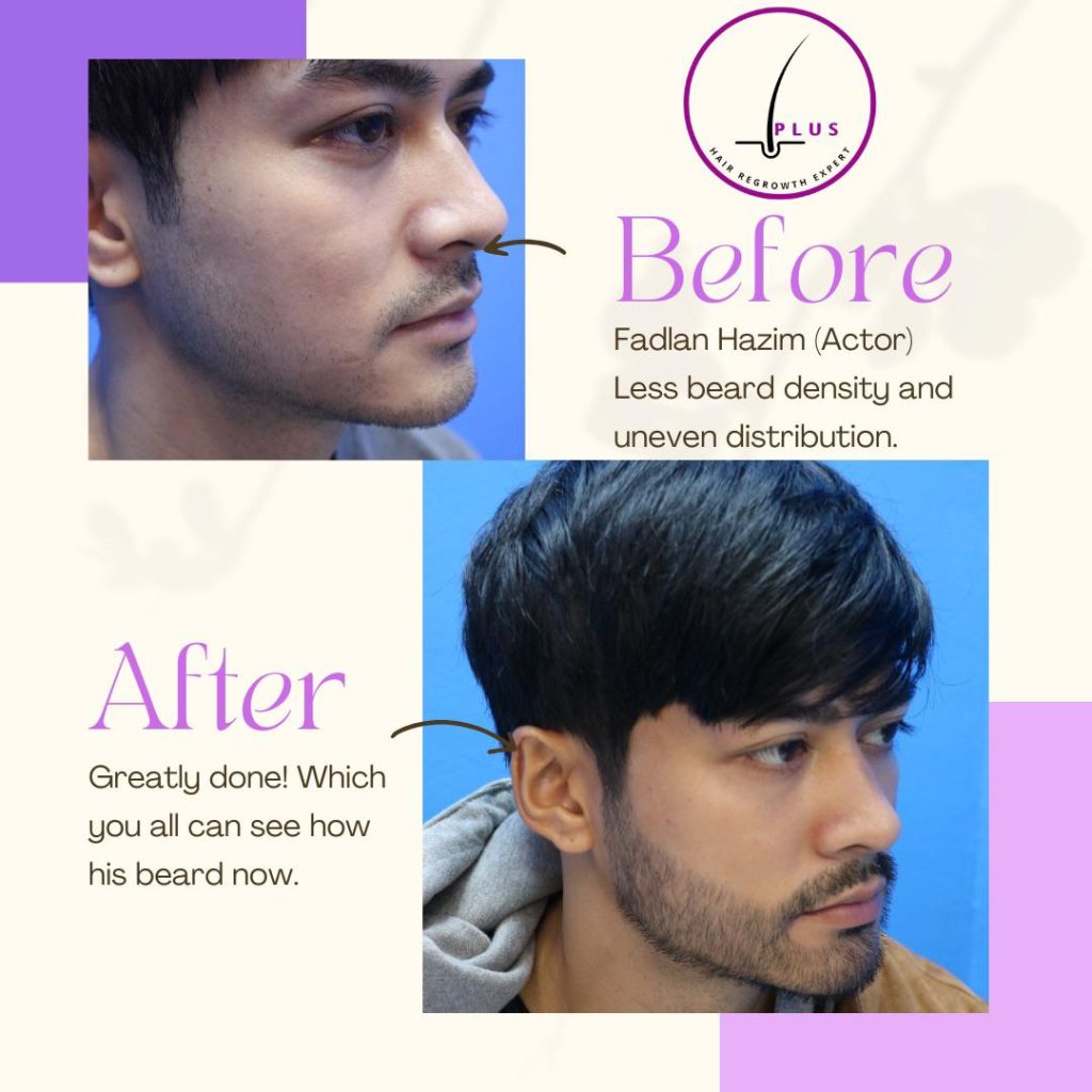 iPlus Hair Regrowth Expert - before after - image 7