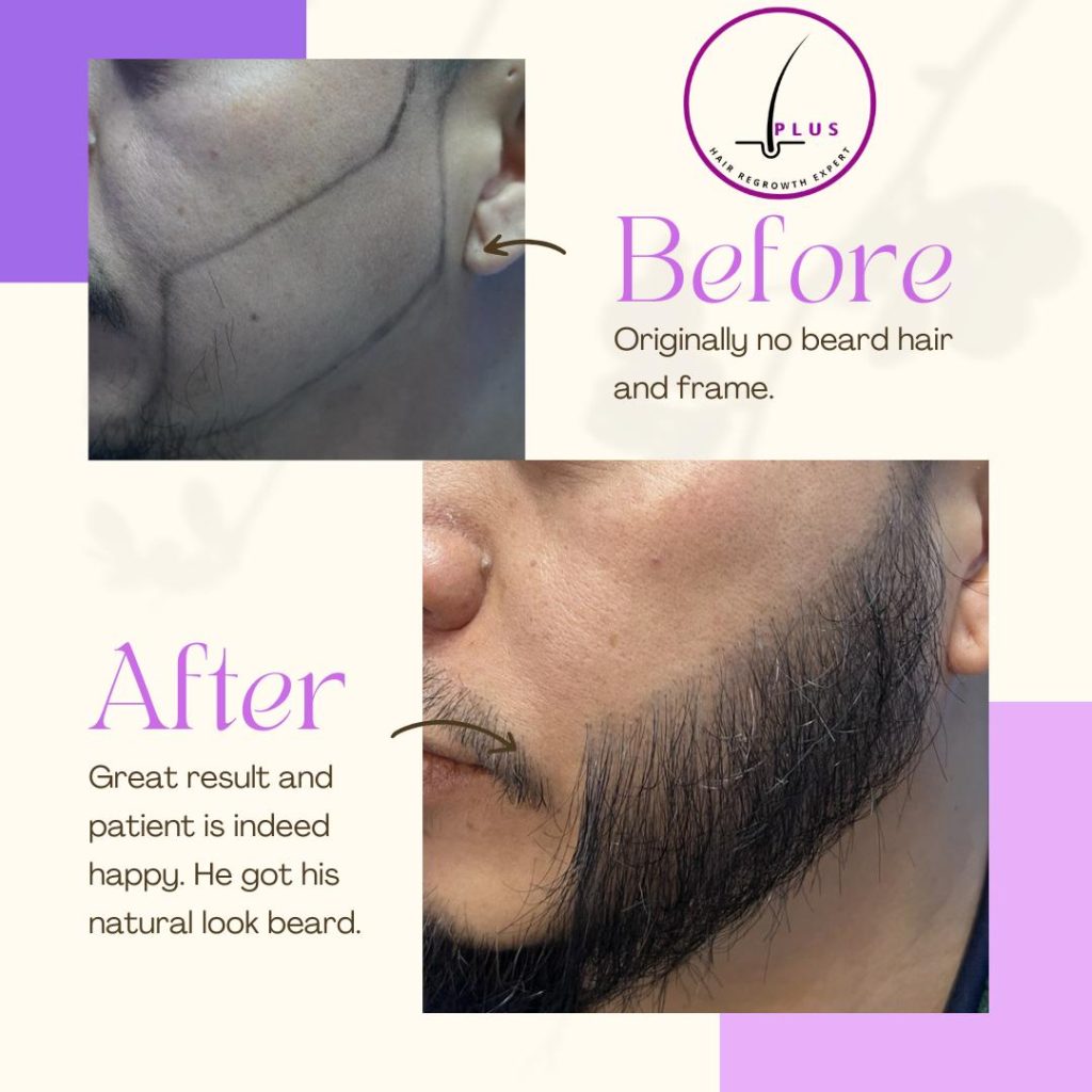 iPlus Hair Regrowth Expert - before after - image 8