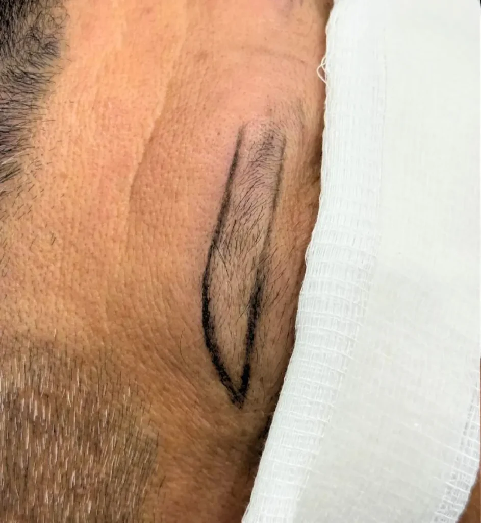 Iplus Hair Regrowth Expert Eyebrow Transplant three