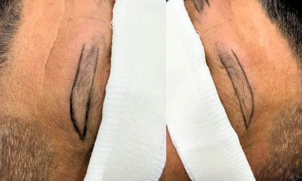 Iplus Hair Regrowth Expert Eyebrow Transplant