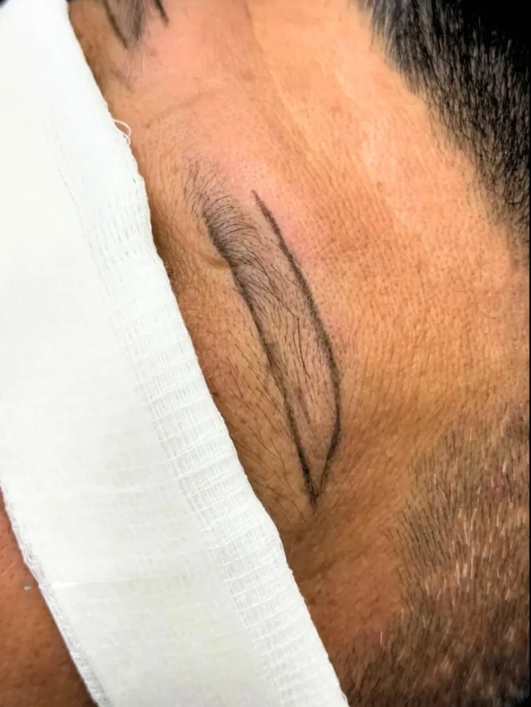 Iplus Hair Regrowth Expert Eyebrow Transplant tow