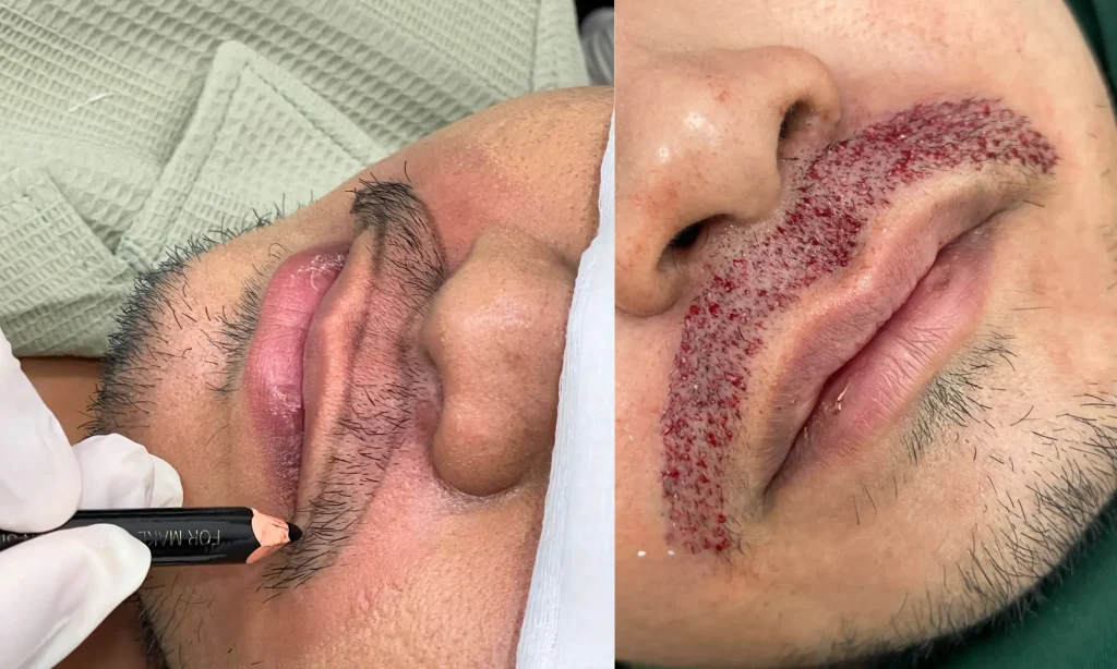 Moustache Transplant