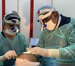 Crown Hair Transplant Test