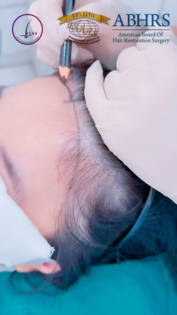 Female Hair Transplant Surgery