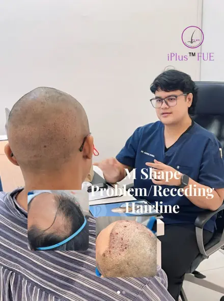 m-shap hair transplant Problem/Receding Hairline