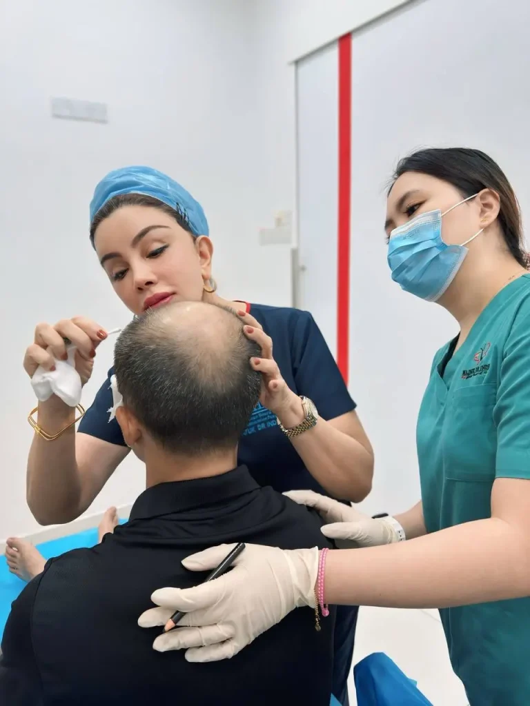 Scalp Micro Pigmentation Treatment