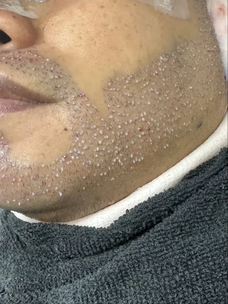 Iplus Hair Regrowth Expert Beard Transplant Tow