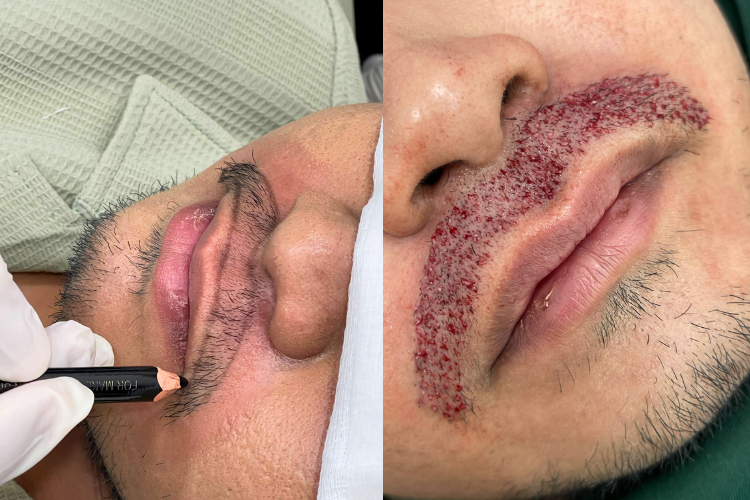 Moustache Transplant (1)