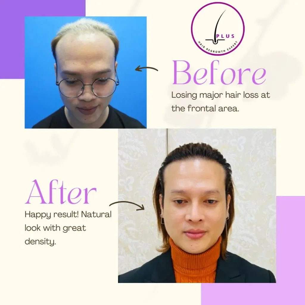 Hair Transplant Before After results using DHI method
